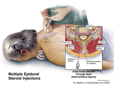 epidural steroid injection in dogs