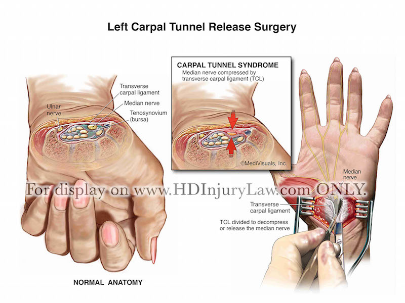 Carpal Tunnel Injury