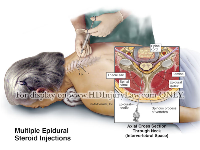 Epidural Steroid Injection Injury