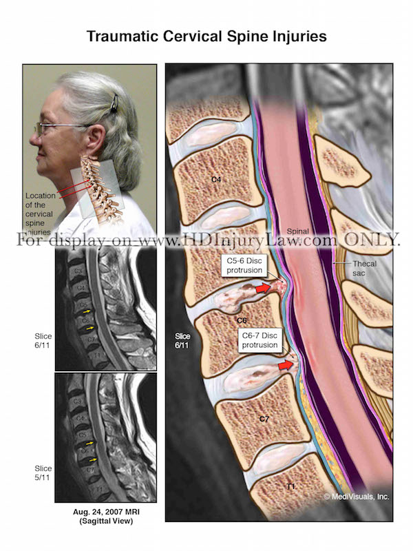 Traumatic Cervical Spine Injuries